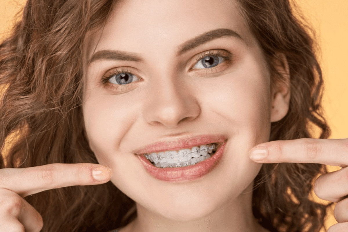 Ceramic braces